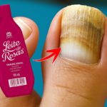 micose de unha com leite de rosas