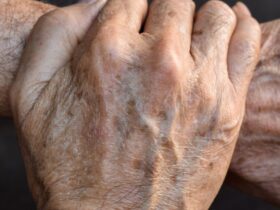 remover manchas de idade naturalmente