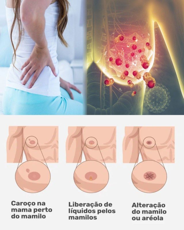 cÂncer de mama 6 sintomas